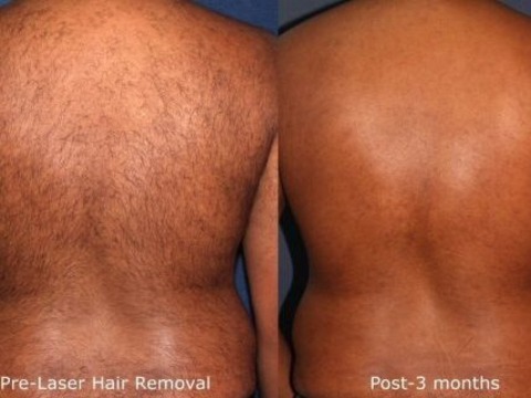 Achieve Smooth Skin with Brazilian Laser Hair Removal in Toronto